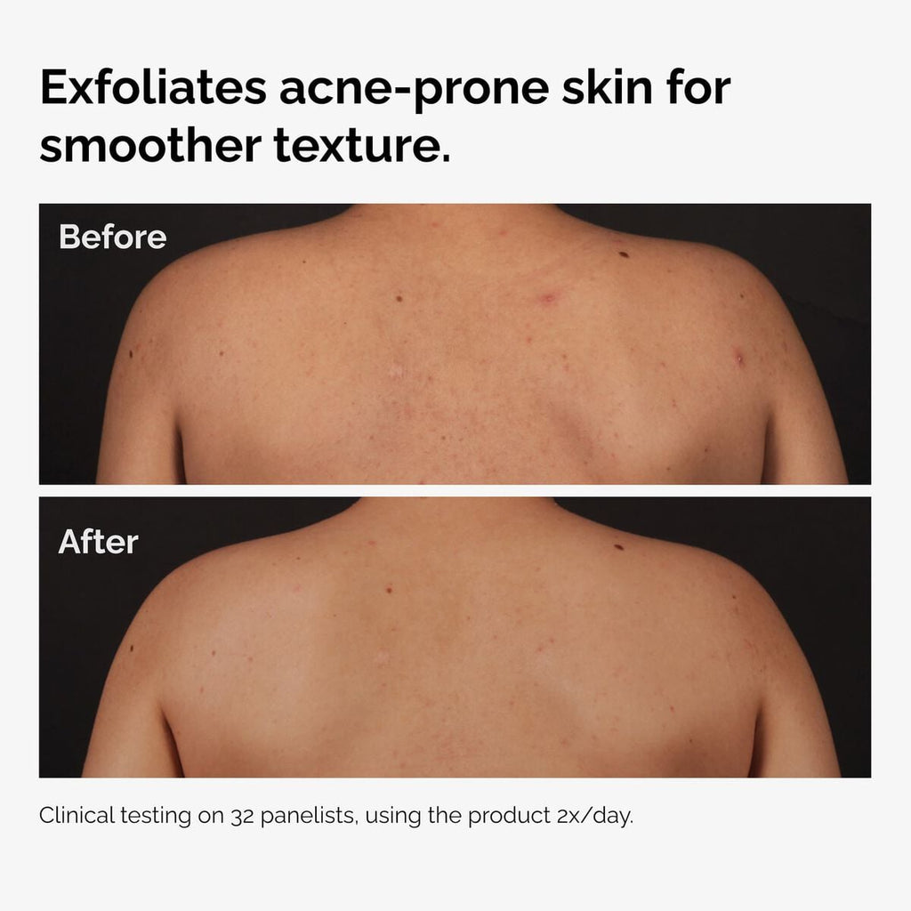 Salicylic Acid Body Serum Targeted Serum Care H9
